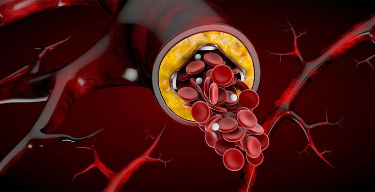A 3D illustration of a partially blocked artery showing plaque buildup and red blood cells struggling to flow through the narrowed vessel.